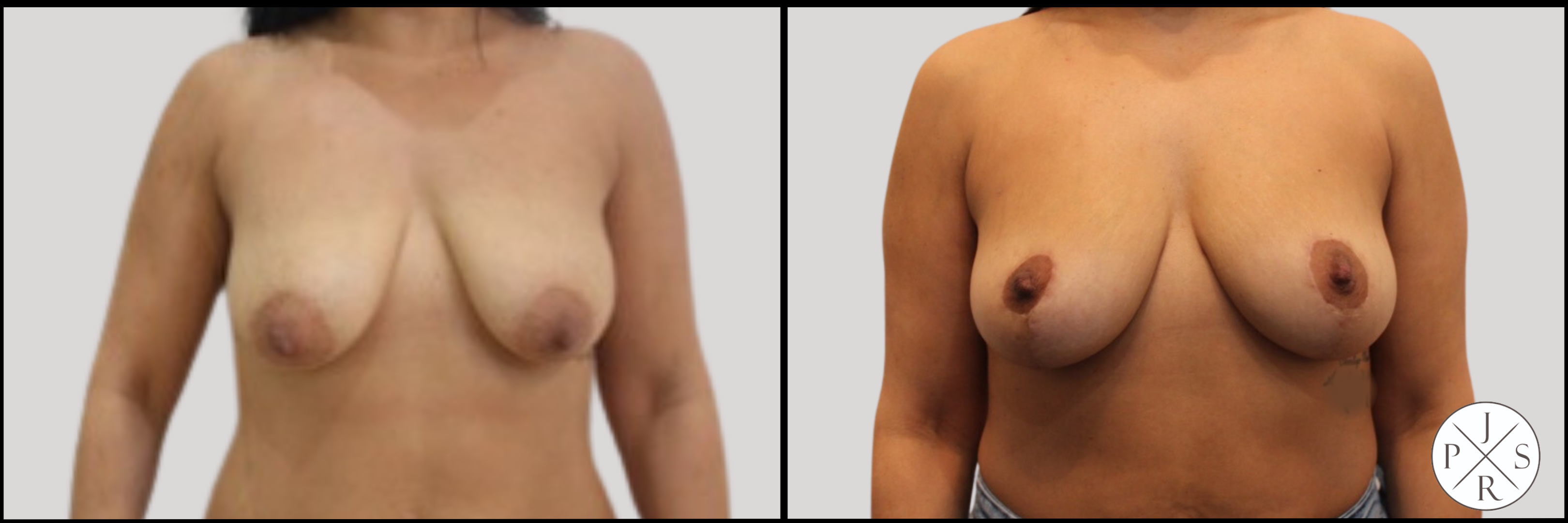 Fat Transfer Breast Augmentation Before & After Image